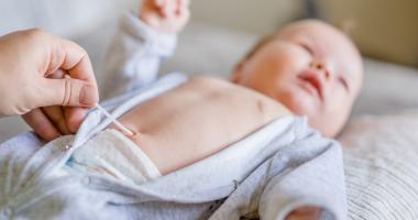 Hernia umbilical Bebé