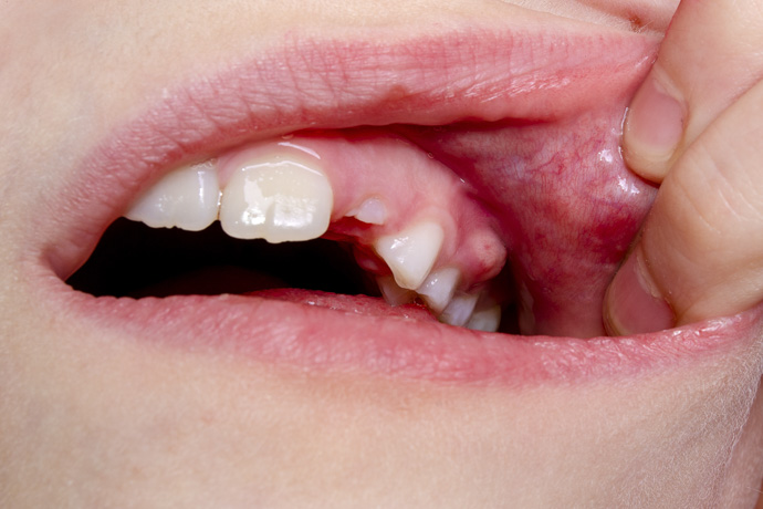Niño con absceso dental
