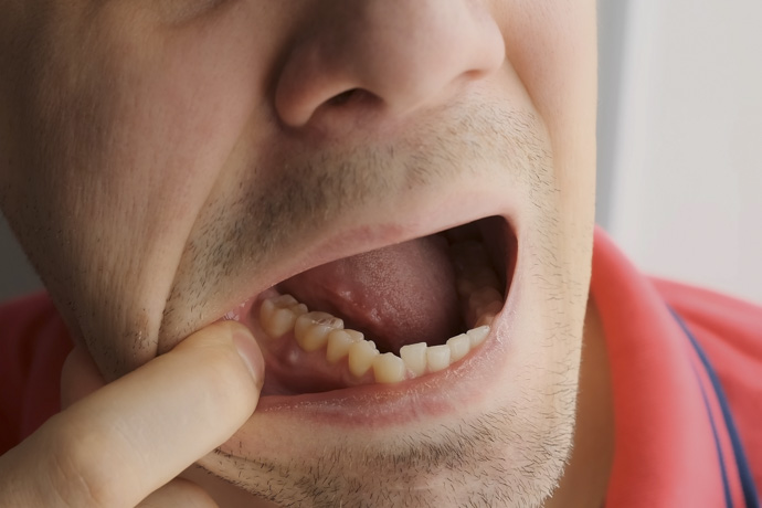 Hombre con absceso dental